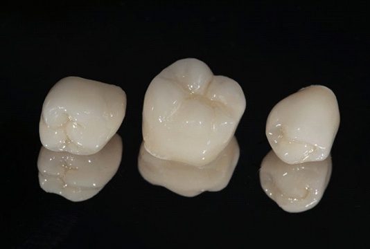 dental crowns in Raleigh