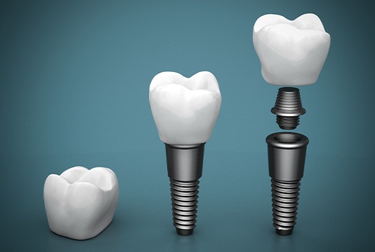 Animations of the parts of dental implant restorations