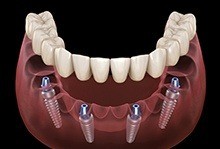 Animation of implant supported denture process