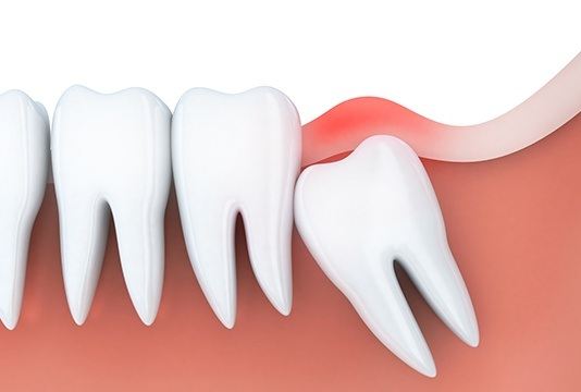 Animation of impacted tooth