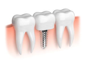 Dental implant set in jaw