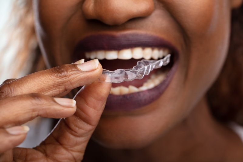 Woman putting clear aligners in her mouth
